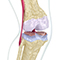 osteoarthritis